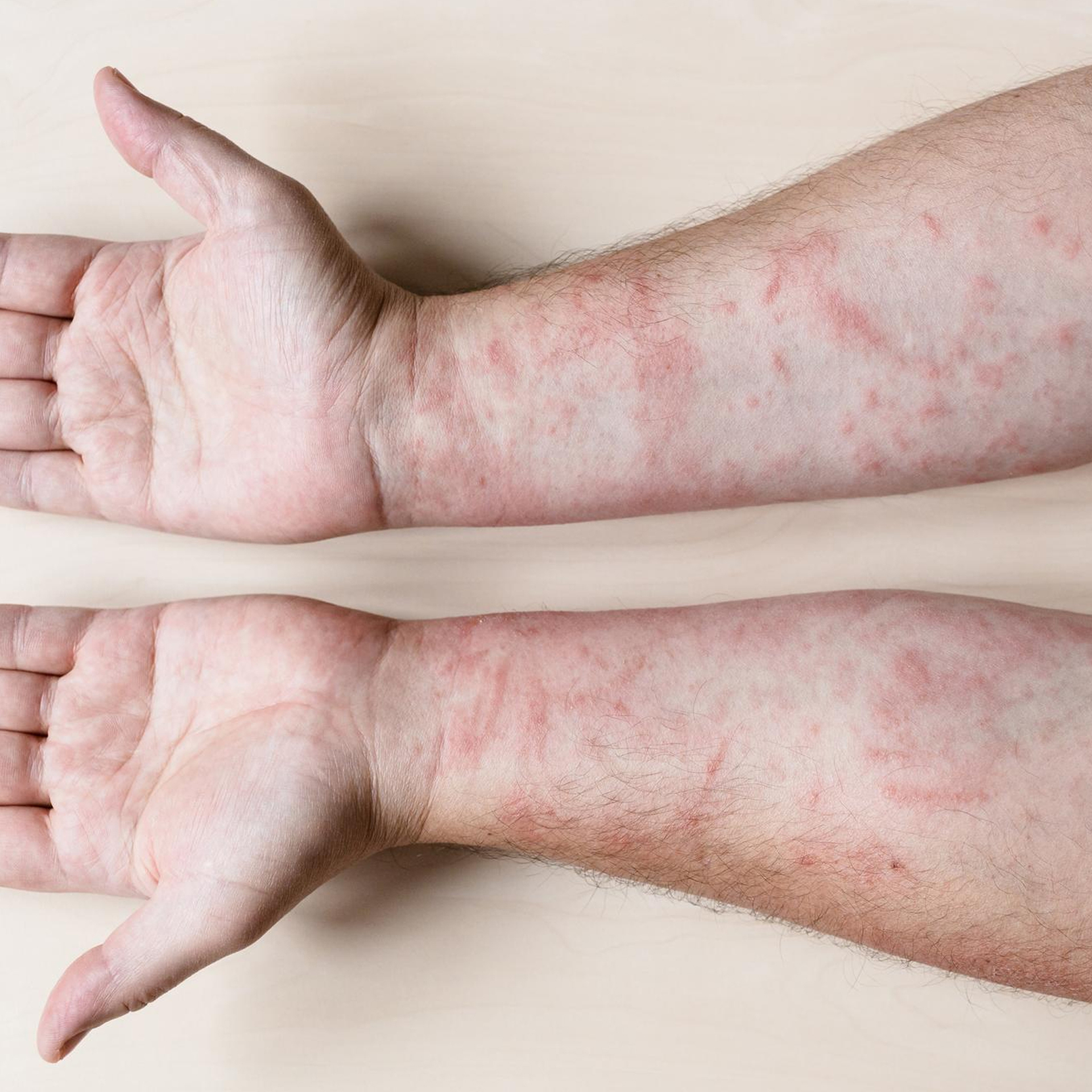 Everything you wanted to know about Skin Allergies (and some) - News :  SilverGuard, Antibacterial bedding, towels, baby products, kitchen  products, masks and snoods with silver protection